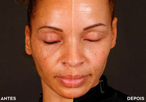 Nivea Luminous 630 Antes E Depois - Luminous 630 Antimarcas: linha completa | Nivea