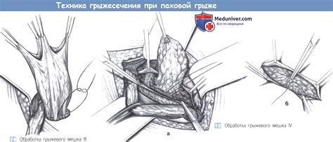 Техника грыжесечения при паховой грыже