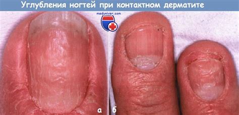 Углубления ногтей при экземе и дерматите