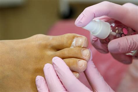 Onychomycosis – Fungus Therapy – fungustherapy.com