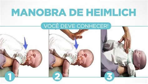 Manobra De Heimlich Em Crianças - Manobra de Heimlich: aprenda como ajudar uma pessoa engasgada ...