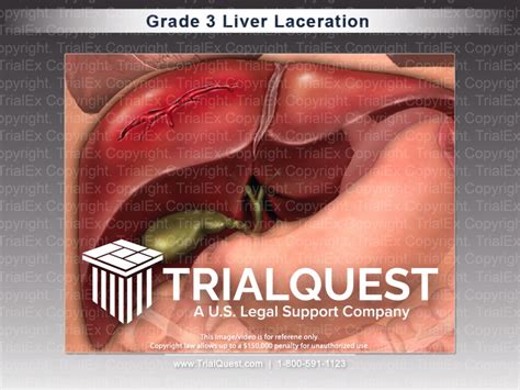 Liver Laceration Grades