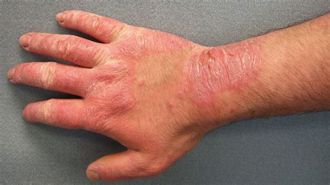 Scaling Skin: Pictures, Causes, Diagnosis, and Treatment