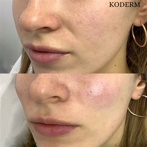 Контурная пластика скул в Минске, цены в KODERM