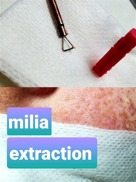 milia extraction cost