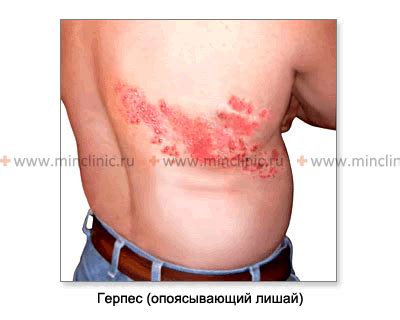 КМН — Невралгия, межрёберная невралгия, герпетический неврит ...