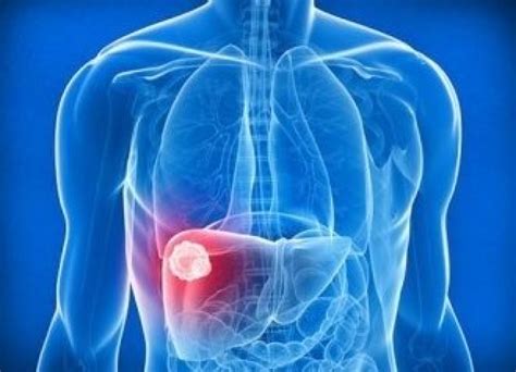 Какви терапии и лечения се използват при рак на черния дроб — Medconsult.bg