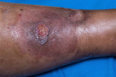Pyoderma gangrenosum - NHS