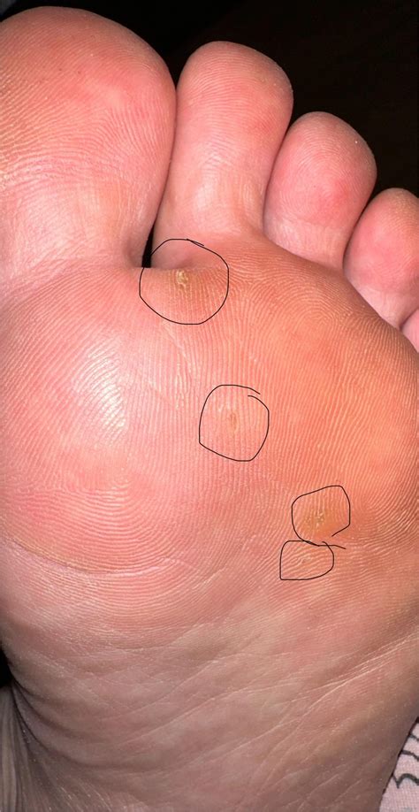 Seed Corns or Plantar Warts? : r/Warts