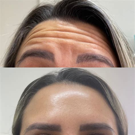 Lemanth Clínica De Estética E Botox - O botox é indicado para... - Lemanth - Clínica Estética