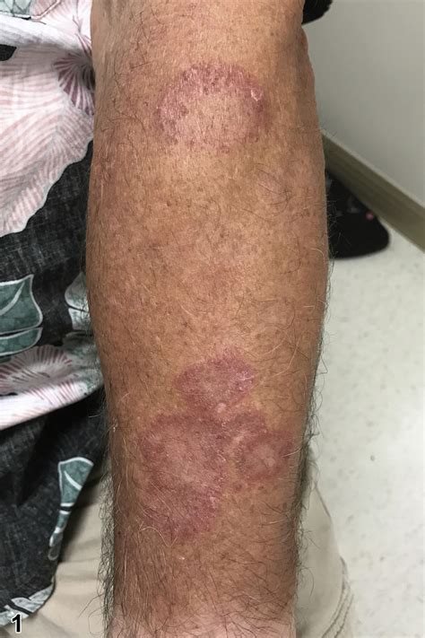 Annular erythematous plaques in the Marianas - JAAD Case Reports
