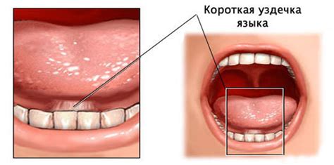 Короткая уздечка - Энциклопедия стоматологии DentalMechanic.ru