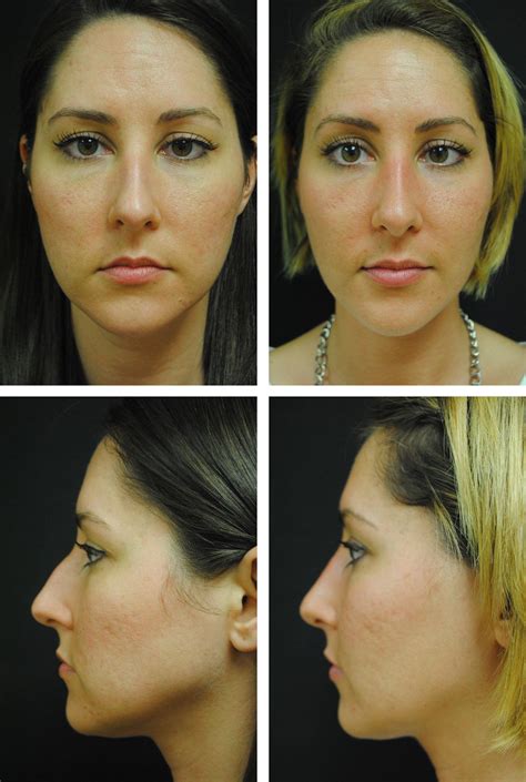 Rhinoplasty - Case 14992 - The Plastic Surgery Group