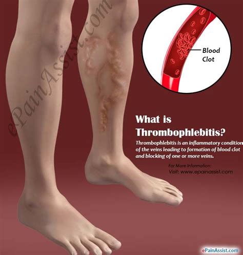 What is Thrombophlebitis & How Can it Be Treated and Prevented ...