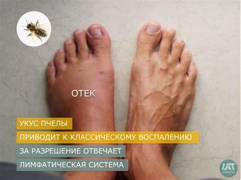 Как отекают ноги при варикозе фото
