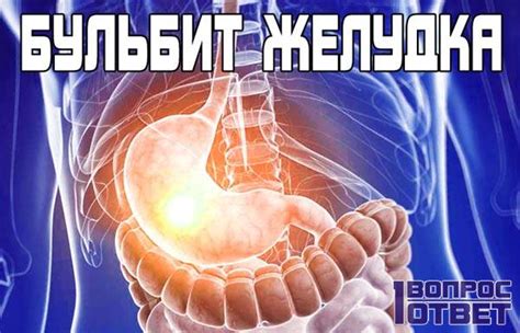 Бульбит желудка: что это за заболевание? Симптомы и лечение бульбита ...