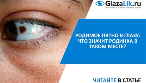 Родимое пятно в глазу: что значит родинка в таком месте?