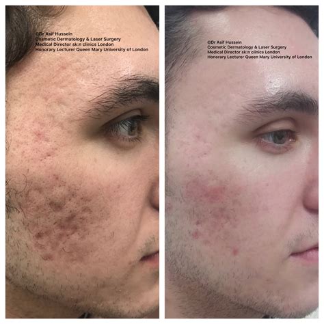 Laser Treatment For Acne Scars Before And After Pictures at Oscar