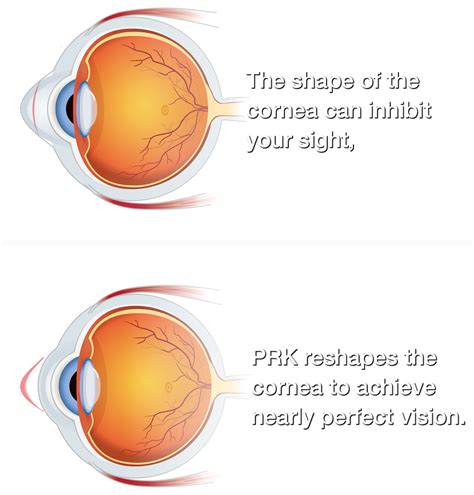 PRK Eye Surgery