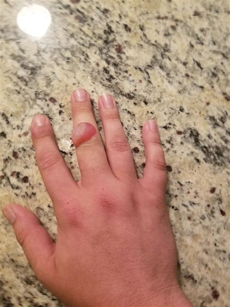 What Happens If You Pop A Frozen Wart Blister at Mary Smithey blog