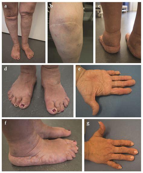 10 Signs Of Ehlers Danlos Syndrome - vrogue.co