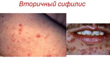 Вторичен сифилис симптоми, признаци, снимка, лечение
