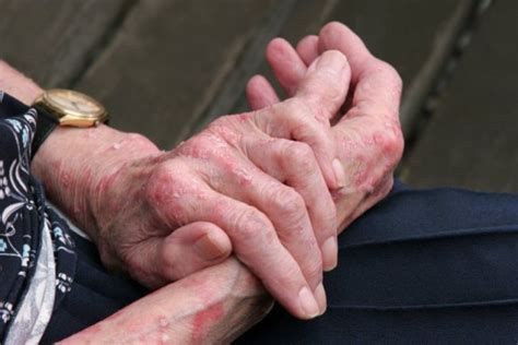 Экзема на руках: симптомы и лечение | MedAboutMe