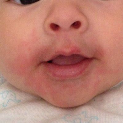 Bolinhas Vermelhas Em Bebes - Ajuda, bolinhas vermelhas ao redor da boca | BabyCenter