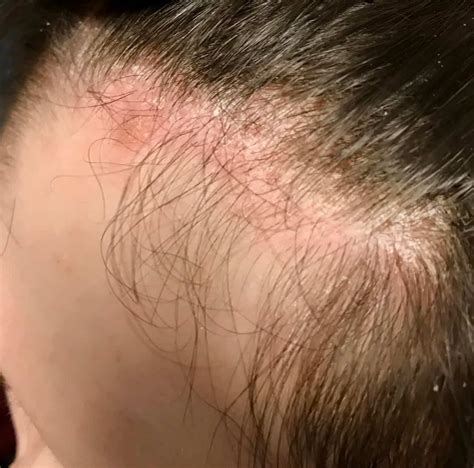 Scalp Psoriasis | Itchy Scalp | Dry Scalp | Scalp Crusting