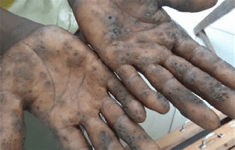 Are extreme weather events making severe skin diseases even worse?