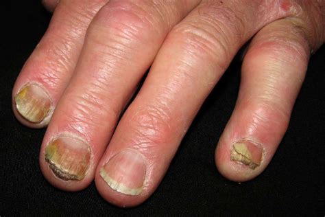 Subungual Hyperkeratosis