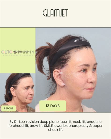 deep plane facelift surgeons  australia  glamjet