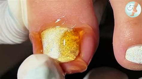 Unhas Com Pus O Que Fazer - UNHA ENCRAVADA COM MUITOOOO PUS - YouTube