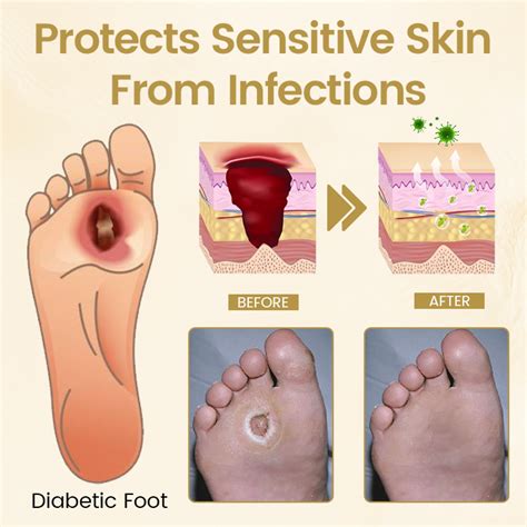 Timilk® Diabetic Foot Healing Spray - Bee Venom Infused - Timilk