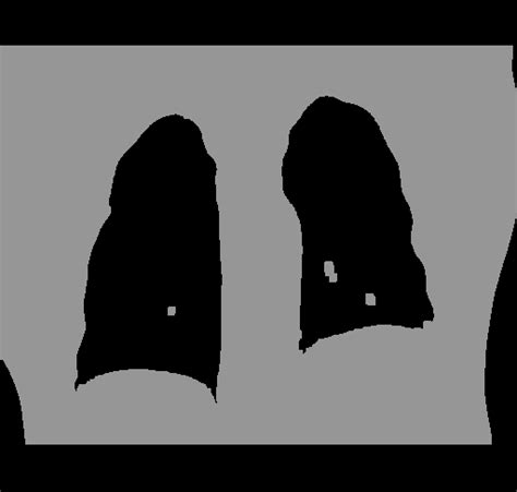 matlab - Segmenting Lungs and nodules in CT images - Stack Overflow