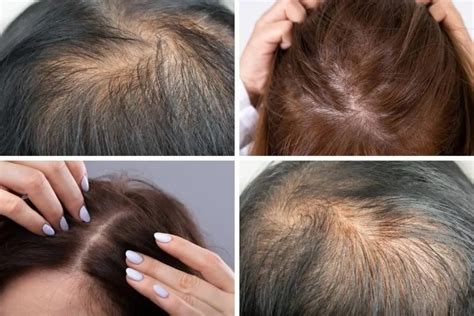 thin hair  solution