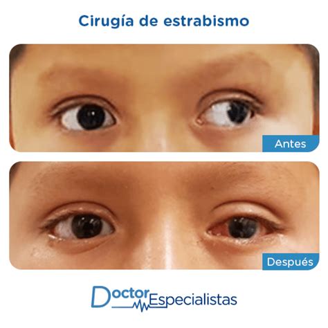 Mejores Oftalmologos Para Cirugia de Estrabismo Doctor Especialistas