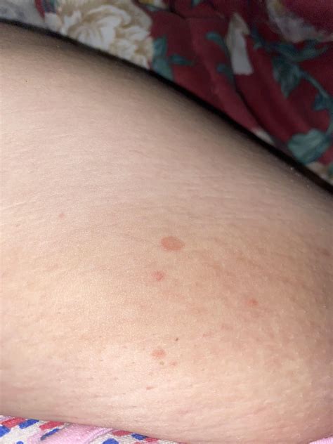 Leg rash? Any idea ? : r/Dermatology
