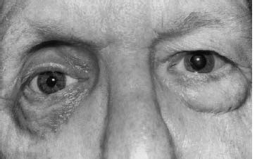 evisceration  enucleation ento key