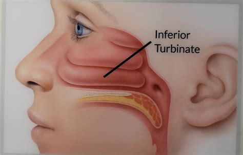 Nasal Turbinate Hypertrophy in New York, NY | The Nose Institute