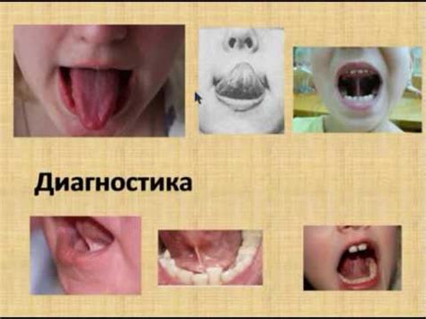 Короткая уздечка языка. Когда нужно подрезать? - YouTube