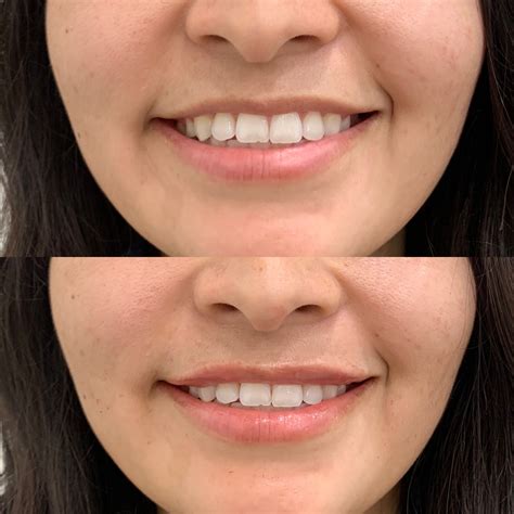 best lip line treatment 11