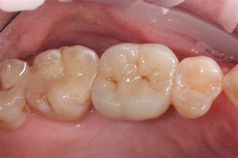 The benefits of tissue level implants restoratively - ITI Blog