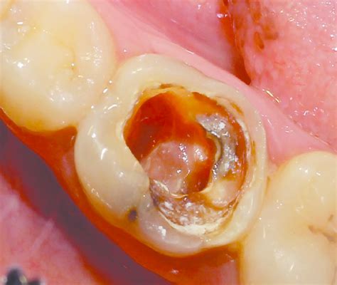 Preoperative photograph exhibiting extensive destruction of the coronal ...