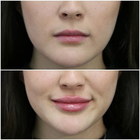 Plastic Surgery Lips Before After | Lipstutorial.org