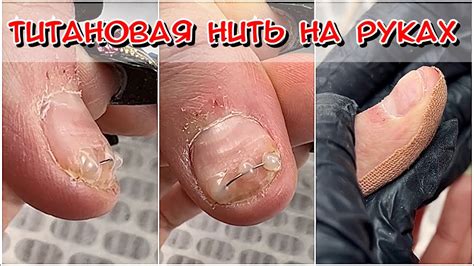 Титановая нить на руках / Коррекционная система на ноготь руки / Травма ...