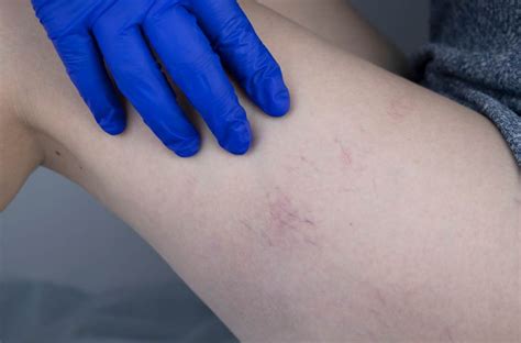Skleroterapia - CKR Filia Warszawa Wola