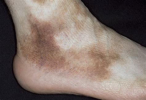 Schamberg's disease: timely diagnosis will help to avoid complications ...