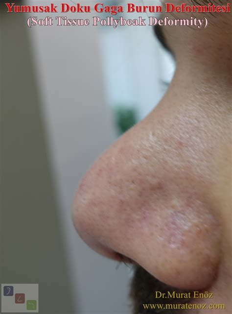 Soft Tissue Pollybeak Deformity
