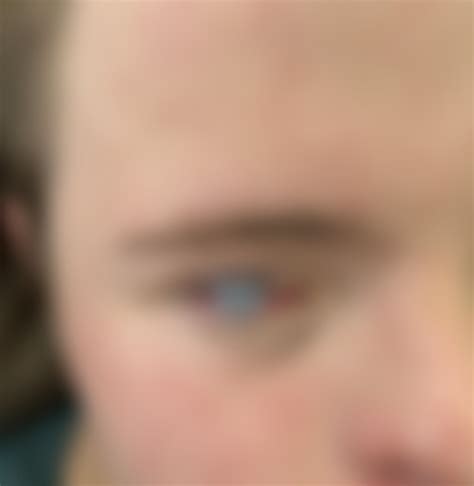 Bulging cornea : r/MedicalGore